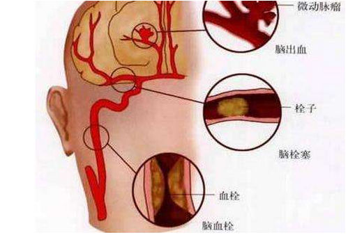 烟台脑血栓的临床类型